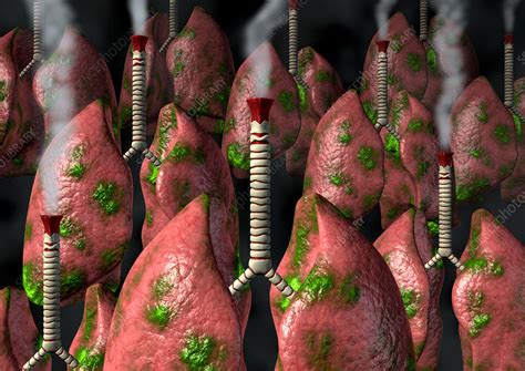 smoker s lungs conceptual artwork stock image m370 1155 science photo library