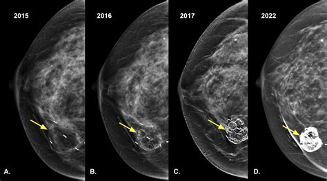 Fat Necrosis Of The Breast Radiology Case