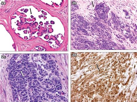 Mesothelioma is most often found after a person sees a health care provider because of symptoms they're having. Malignant mesothelioma of tunica vaginalis: an extremely ...