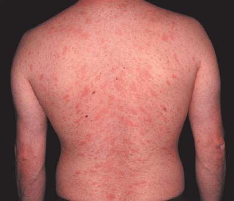 Pityriasis Rosea Salmon Colored Oval Macules With Collarette Like