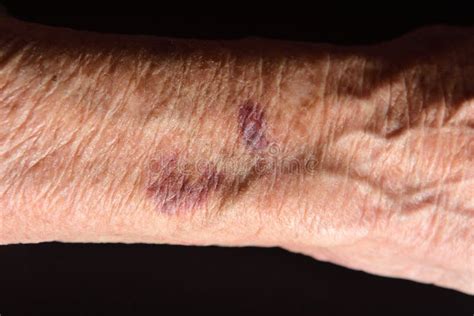 Close Up Of A Bruise In The Arm Of Senior Woman Stock Photo Image Of
