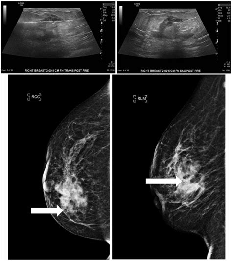 Granulomatous Mastitis Of The Breast A Malicious Mimic Frederick J