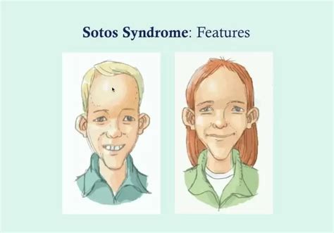 Sotos Syndrome Symptoms Causes And Treatment