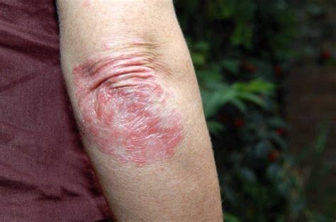 What Is Psoriasis Causes Treatments DermaBlue Asheville