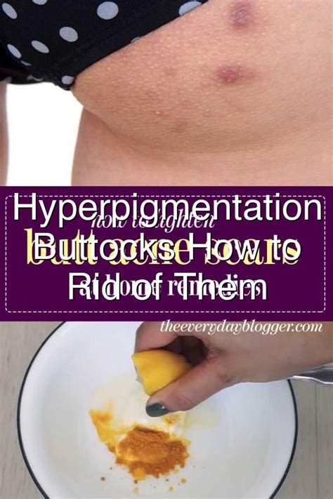 Hyperpigmentation On Buttocks How To Get Rid Of Them Butt Acne Acne