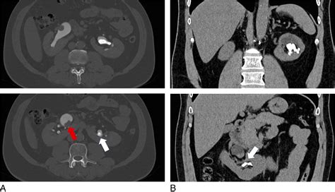 Bilateral Nephrolithiasis And Upper Tract Transitional Cell