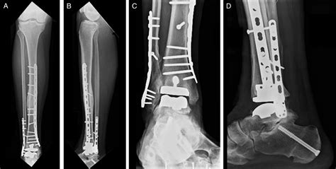 Post Traumatic Periprosthetic Tibial And Fibular Fracture After Total