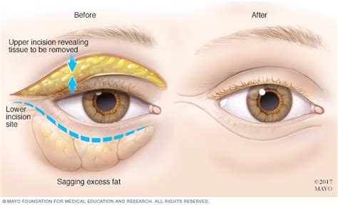 Bags Under Eyes Diagnosis And Treatment Mayo Clinic