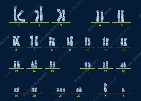 Down syndrome or down's syndrome, also known as trisomy 21, is a genetic disorder caused by the presence of all or part of a third copy of chromosome 21. Male karyotype with Down's syndrome - Stock Image - C016/6749 - Science Photo Library