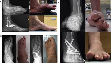 Clinical And Radiological Outcomes Of Midfoot Derotational Osteotomy