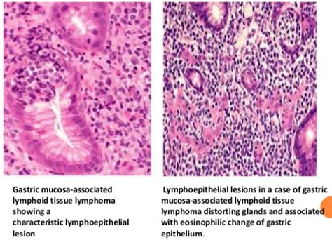 Malt inductive sites are secondary immune tissues where antigen sampling occurs and immune responses are initiated. mucosa-associated lymphoid tissue(MALT) lymphoma : 네이버 블로그