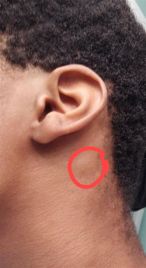 Swollen Lymph Node Behind Ear For A Month Should I Finally See A