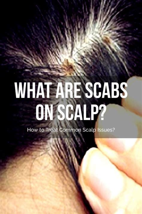 Scabs On Scalp Scabs On Scalp Scalp Issues Thick Hair Remedies
