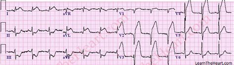 Anterior Wall St Segment Elevation Mi Ecg Review Learn The Heart