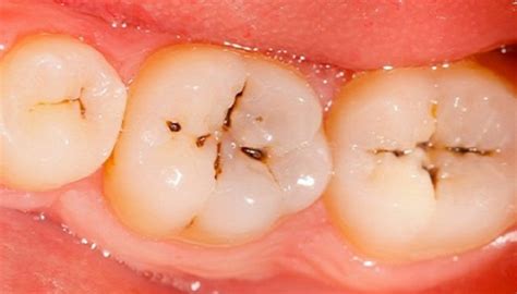How Are Cavities Treat Edmonton Downtown Dentist