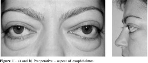 Scielo Brasil Surgical Treatment Of Endocrine Exophthalmos By