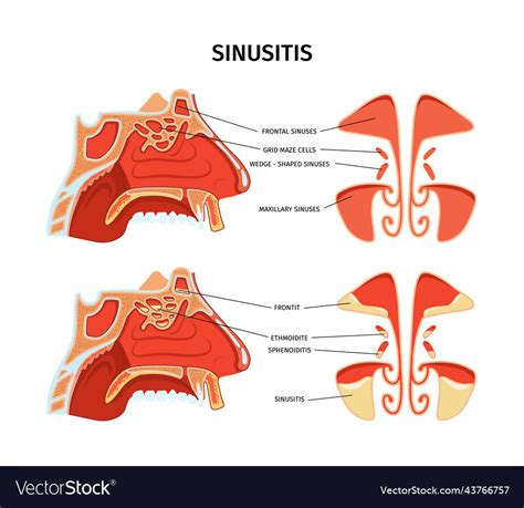 Sinusitis Infographics Royalty Free Vector Image