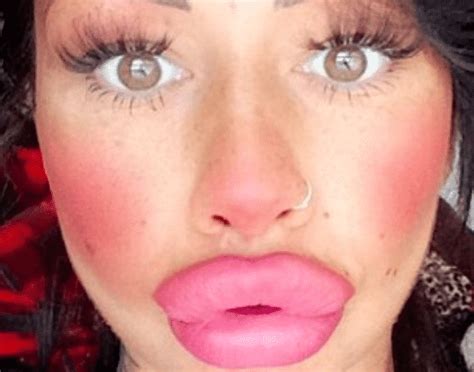 Elle Se Fait Injecter 65 Ml De Botox Dans Les Lèvres Découvrez Le Résultat
