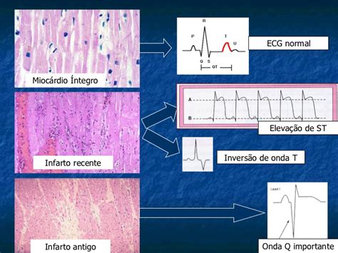 O enfarte agudo do miocárdio (eam) é uma das principais causas de morte em portugal e o seu prognóstico está diretamente relacionado com o tempo de evolução entre o início dos sintomas e o seu tratamento. Infarto agudo do miocárdio | CliqueFarma