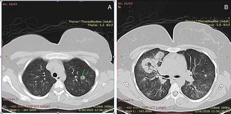 A Axial Image Of Chest Computed Tomography Ct Scan Showed A