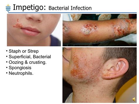 Ppt Pathology Of Skin Common Disorders Powerpoint Presentation