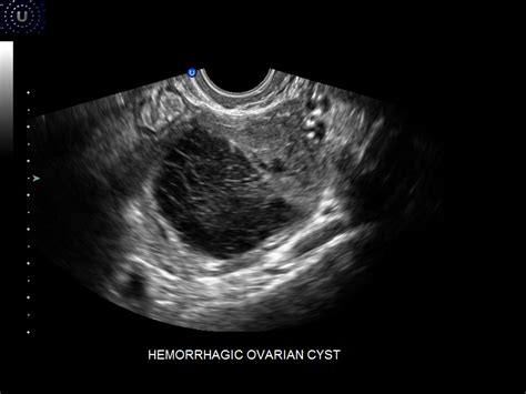 Bilik Sonografer Kista Ovarium