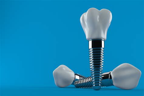 Cu Les Son Las Ventajas De Los Implantes Dentales Para Tu Sonrisa
