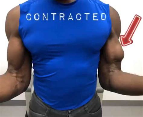 Biceps Tendon Rupture Shoulder