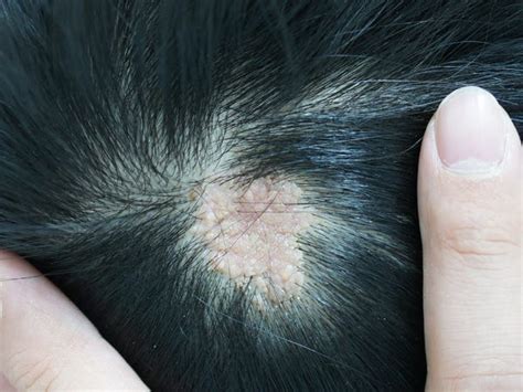 What Skin Cancer Looks Like A Pimple Skin Cancer Warning Arcadia