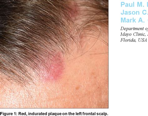 Figure 1 From Dermoscopy Of Primary Cutaneous B Cell Lymphoma