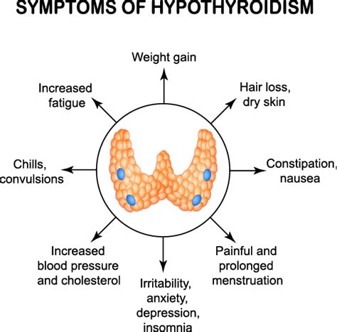 Hypothyroidism Underactive Thyroid Symptoms Diagnosis And Treatment