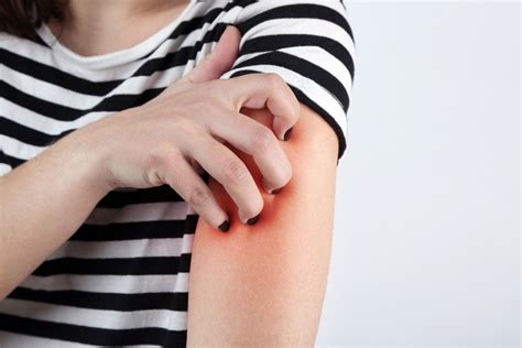 Hives Are An Allergic Reaction That Take The Form Of Itchy Red Bumps Or