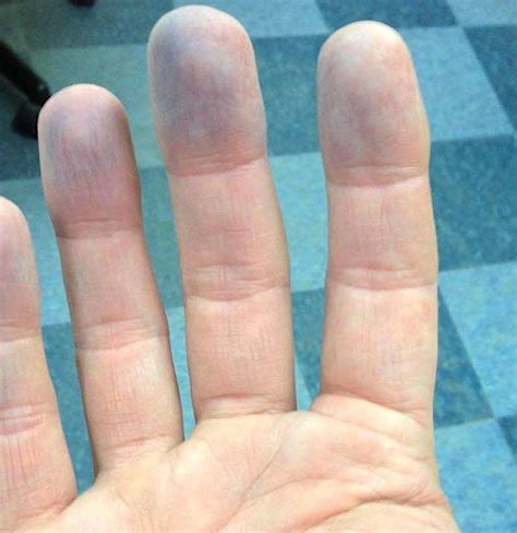Peripheral Cyanosis Symptoms Causes Diagnosis And Treatment