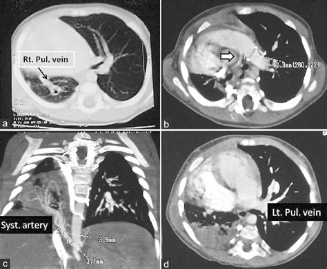 A Chest Ct Shows Hypoplasia Of The Right Lung Mediastinal Shift And