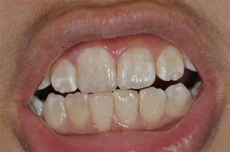 What To Do About White Spots On Your Teeth Balsall Common Dental