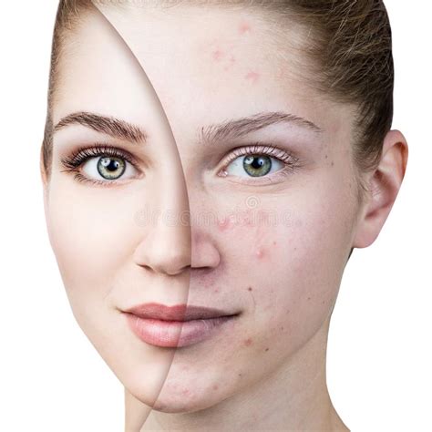 Young Woman With Acne Before And After Treatment Stock Image Image
