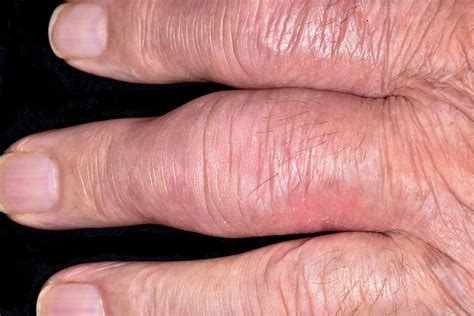 Fingers In Osteoarthritis Photograph By Dr P Marazziscience Photo Library
