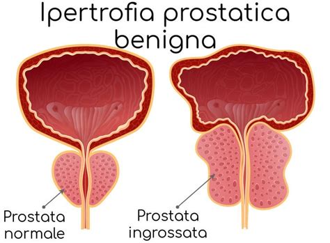 L Ipertrofia Prostatica Benigna Le Cure I Sintomi E Le Cause Bio My