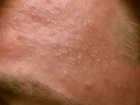 Flesh Colored Bumps On Forehead Bing Images