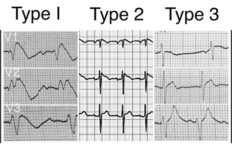 Brugada Syndrome And Sports Activity From History To Risk Stratification