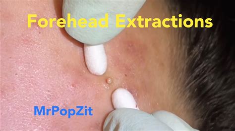Forehead Acne Extractions Blackheads Whiteheads Milia Popped Pores