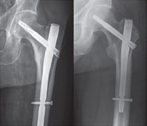 Increased Failure Rates After The Introduction Of The Tfna Proximal