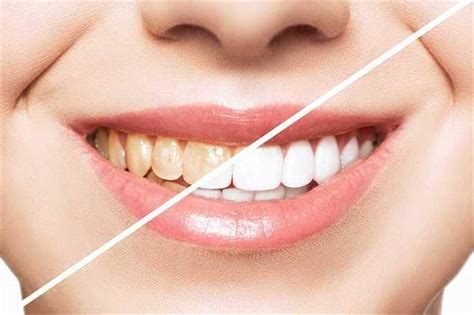 Tooth Discoloration Causes Treatment And Prevention