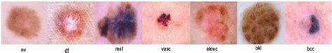 Multiclass Skin Lesion Classification With Cnn And Transfer Learning Images