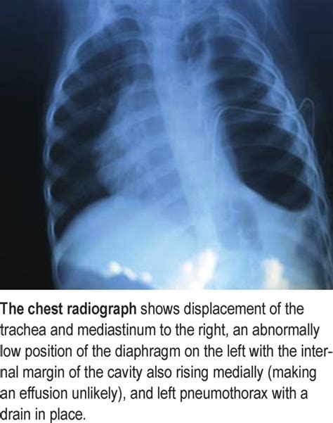 A Rare Differential Diagnosis Of Tension Pneumothorax 13032020