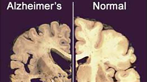 Researchers Testing Stem Cells To Treat Alzheimers In First Of Its