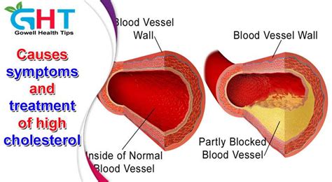 What Are The Causes Symptoms And Treatment Of High Cholesterol
