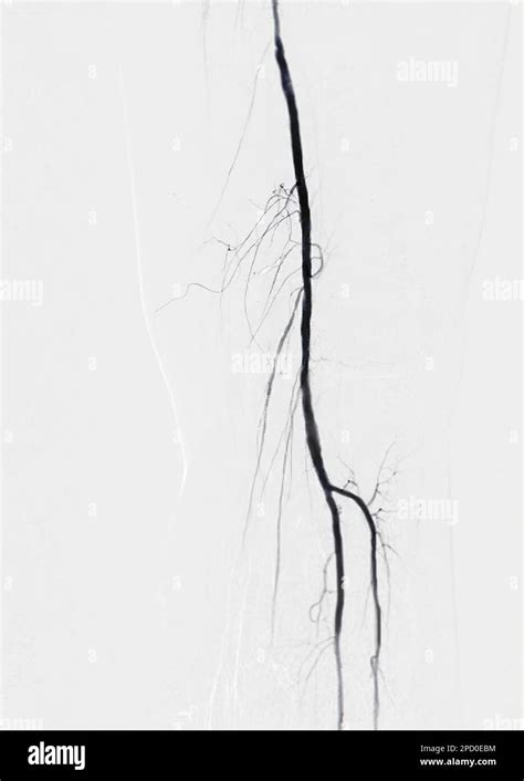 Femoral Artery Angiogram Or Angiography Stock Photo Alamy