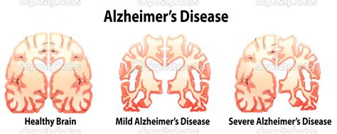 Alzheimers And Dementia Causes Difference Risk Factors And Treatment