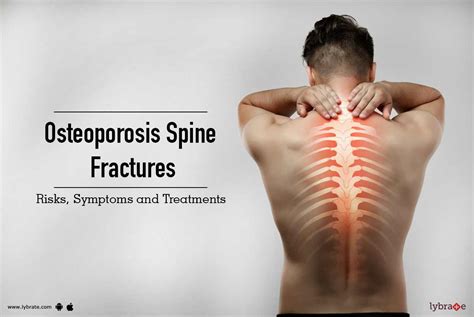 Osteoporosis Spine Fractures Risks Symptoms And Treatments By Dr